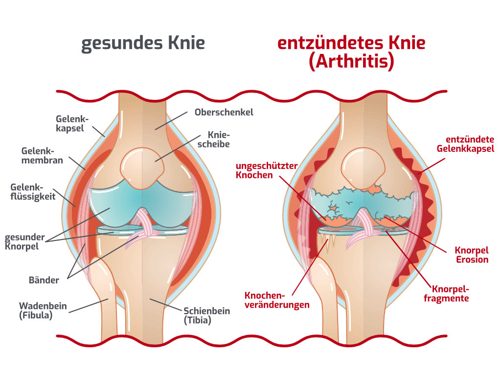 Arthrose versus Arthritis