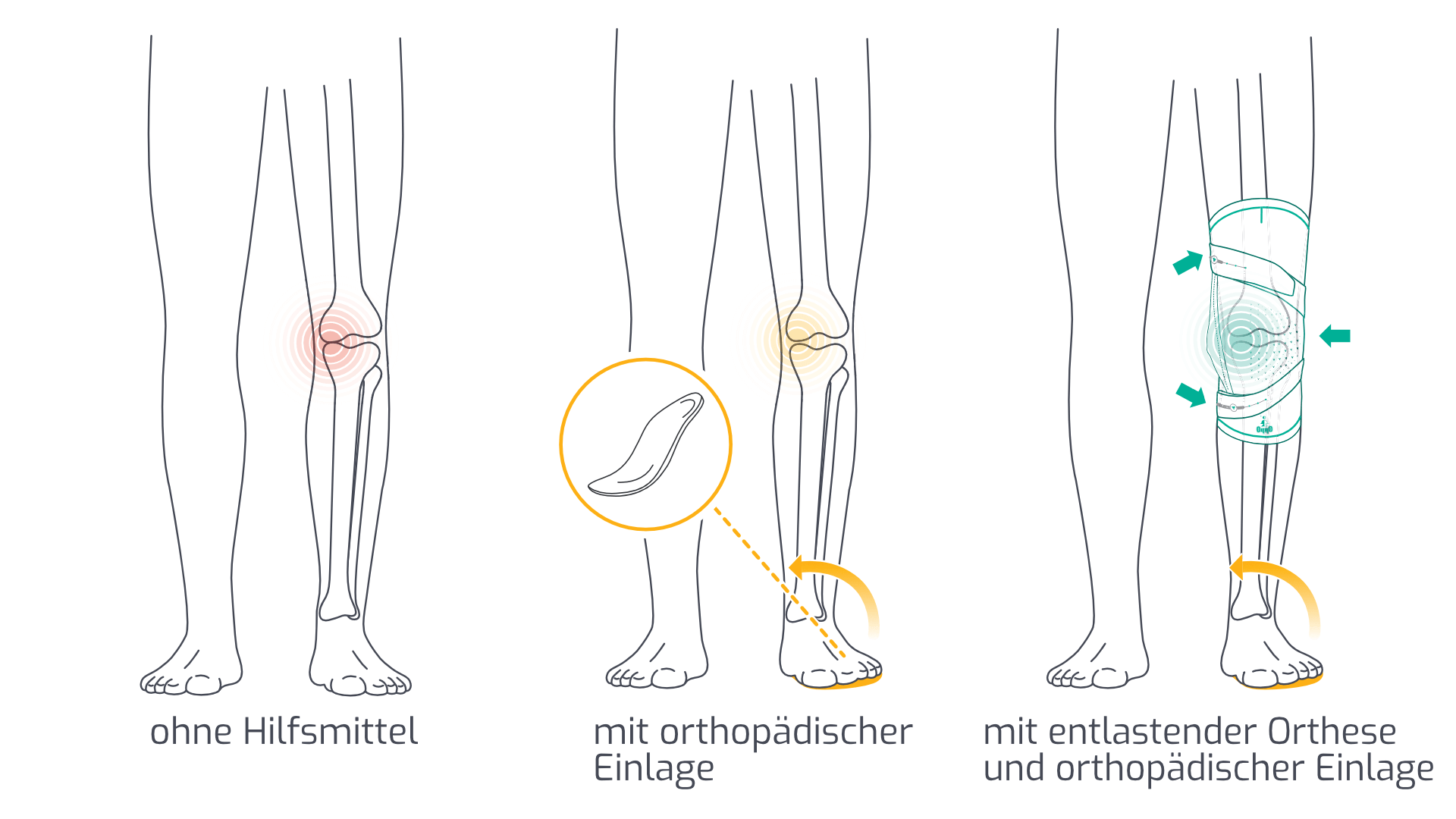 Arthrose Entlastungsgrafik mit Einlage und Orthese